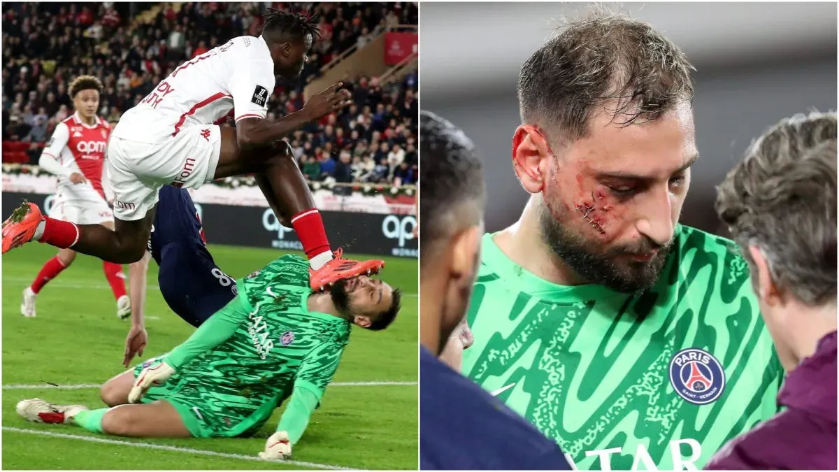 Donnarumma Facial Damage Monaco